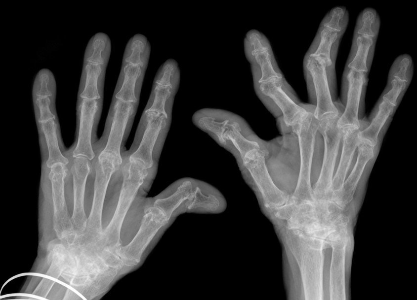 Mehr Beweglichkeit durch KI: Individualisierte Fingergelenksimplantate aus dem 3D-Drucker